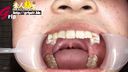 清純女子大生の紗月ちゃん最近虫歯が出来た口腔内を開口器接写鑑賞