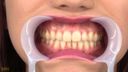結衣ちゃんの【歯】観察。左上6番に銀歯発見！