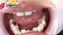여대생의 기록적인 은색 치아 수에 감탄! 입 구멍으로 큰 수치심 구강 진단