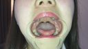 Oral video Thick blood vessels on the back of the tongue