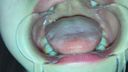 Oral video Thick blood vessels on the back of the tongue