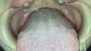 Oral video Thick blood vessels on the back of the tongue