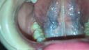 Oral video Thick blood vessels on the back of the tongue