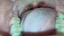 Oral video Thick blood vessels on the back of the tongue