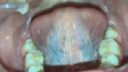 Oral video Thick blood vessels on the back of the tongue