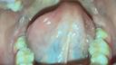 구강 비디오 혀 뒤쪽의 두꺼운 혈관
