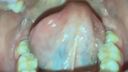 Oral video Thick blood vessels on the back of the tongue