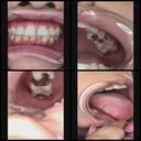 嘴巴的特寫，銀牙和喉嚨雞巴螞蟻！ 門牙是蛀牙嗎？