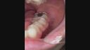 Close-up of the mouth and bad teeth gal! Are you removing the nerves in your front teeth? The throat dick video is also an ant!