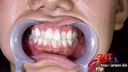 65mm long-tongue sister Nao Hamasaki's silver teeth refilled with white!? Wisdom tooth oral appreciation