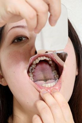 あかりちゃんの歯　銀歯をスケーラーで突いてみた