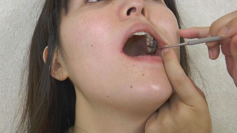 あかりちゃんの歯　銀歯をスケーラーで突いてみた
