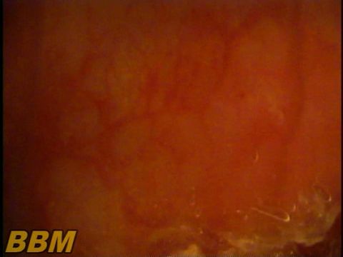 肛門観察【内視鏡カメラ】で見る腸内・腸壁・毛細*管